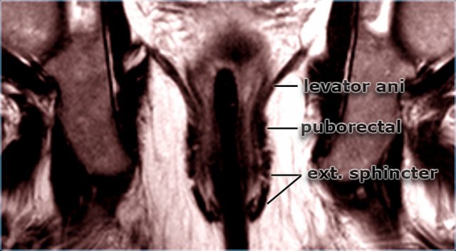 Coronal T2W-image