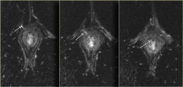 Transsphincteric fistula with sphincter defect at 11 o'clock