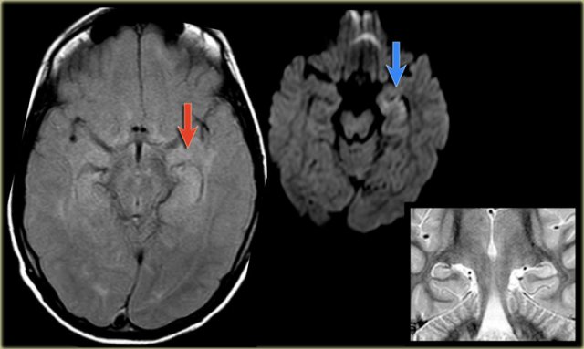 Status epilepticus. Axial FLAIR, axial DWI and coronal T2WI.