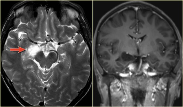 Hyperintense hippocampus due to a DNET