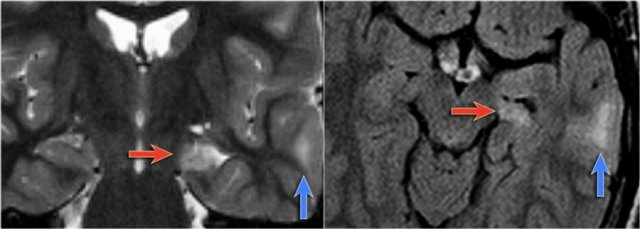 Dual pathology: MTS and focal cortical dysplasia