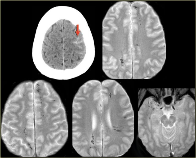 Diffuse axonal injury