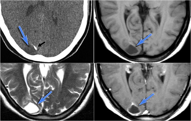 Ganglioglioma in the right occipital lobe presenting as a cystic mass with rim enhancement. Notice calcification on CT.