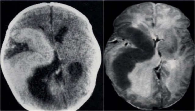 Hemimegalencephaly. Courtesy of Alessandra D'Amico