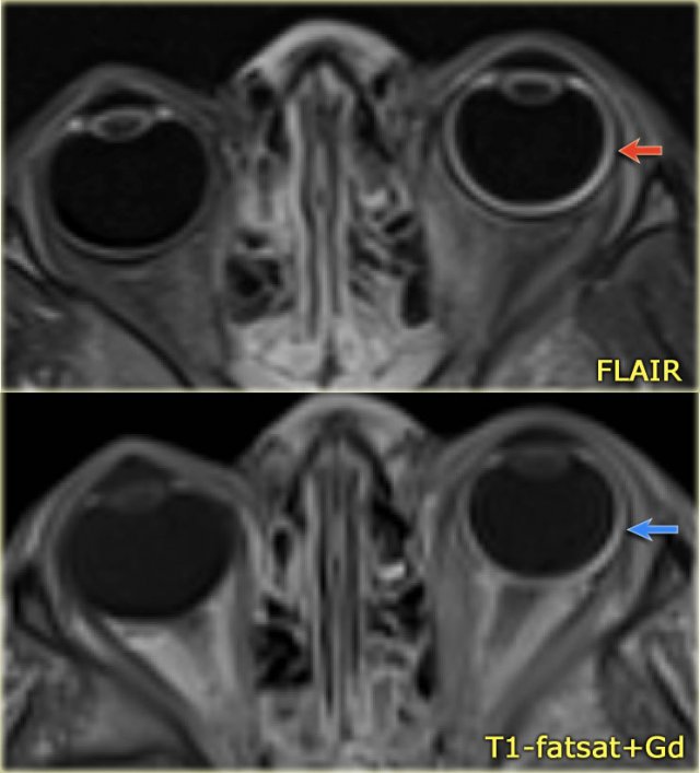 Sturge-Weber. Axial FLAIR and CE-T1WI with fatsat. Diffuse choroidal hemangioma