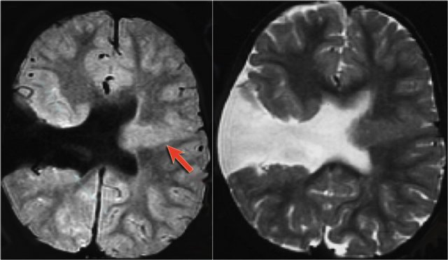 Schizencephaly