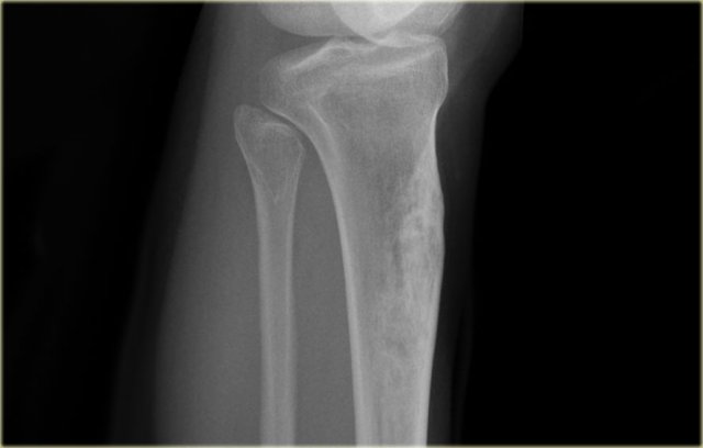 Fibrous dysplasia