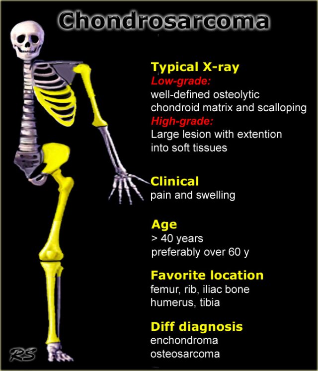 Low-grade chondrosarcoma