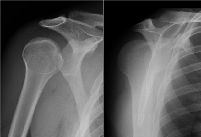 Posterior dislocation