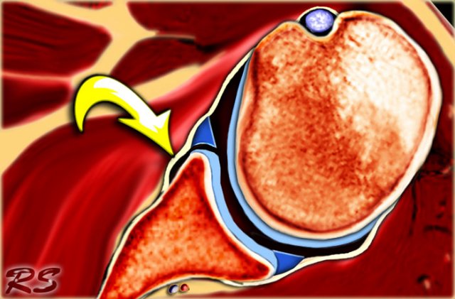 Perthes lesion: the labrum is thorn, but the periosteum is intact and only stripped (arrow)