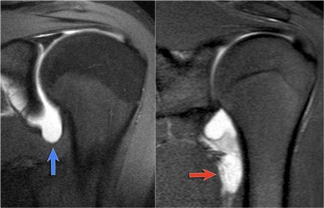 LEFT: Normal axillary recess (blue arrow). RIGHT: Abnormal axillary recess due to avulsion of the IGHL (red arrow)