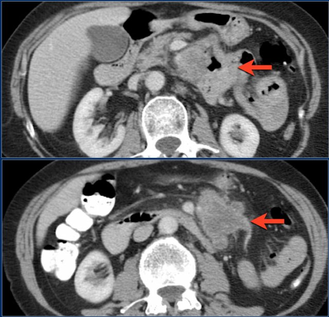 Adenocarcinoma in the jejunum