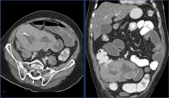 Lymphoma in the terminal ileum