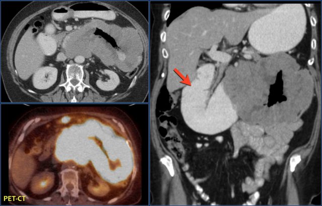 Lymphoma in the proximal jejunum