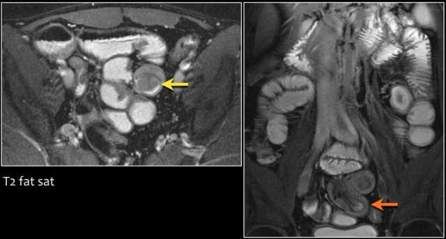 Patient with Peutz-Jeghers syndrome with ileal polyp as leadpoint for intussusception. 