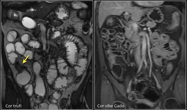 History of ileocecal resection. Focal ileal wall thickening with some enhancement in Crohn's disease.