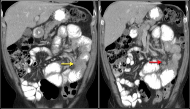 Adenocarcinoma in the jejunum