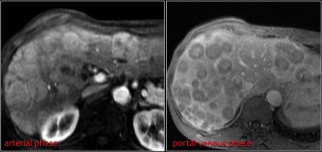 Multiple livermetastases of a carcinoid tumor.