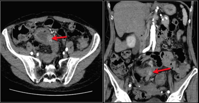 Carcinoid presenting as hyperenhancing lesion in the late arterial phase