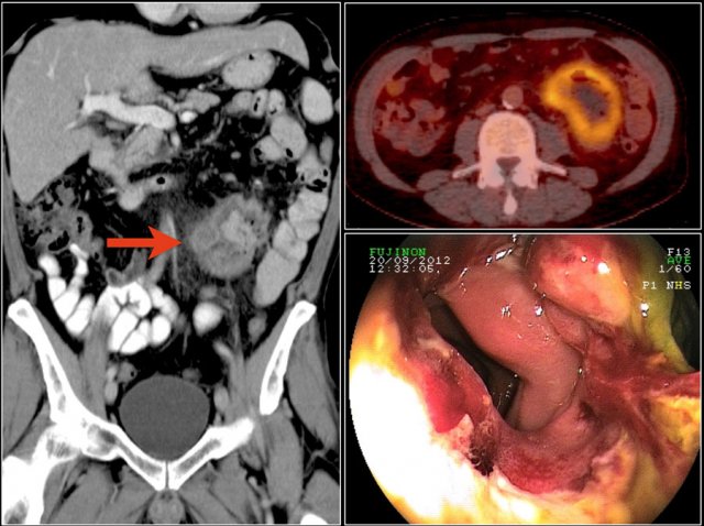 EATL lymphoma in a patient with celiac disease.