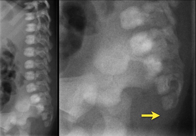 Newborn girl with an anorectal malformation. The distal sacrum below S4 is absent.