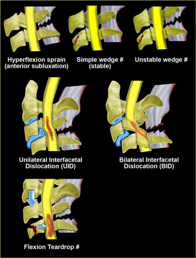 Hyperflexion injuriesClick on the image to get a larger view.