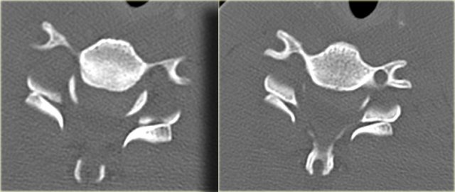 Double inverted hamburger sign in bilateral facetal dislocation