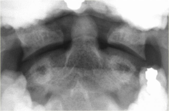 Prominent mach line mimicking an odontoid fracture