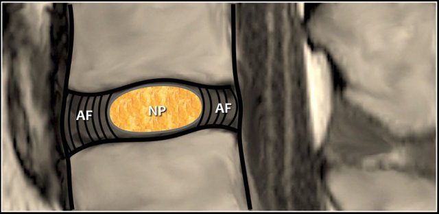 Disc is composed of soft nucleus pulposus (NP) surrounded by strong annulus fibrosus (AF)