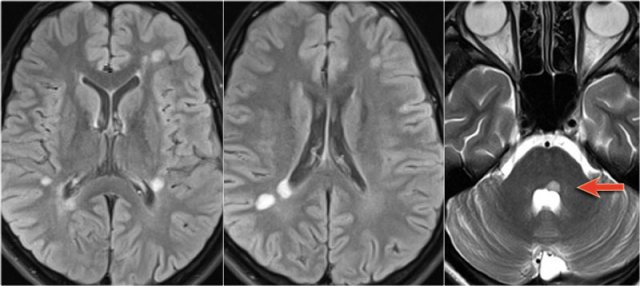 Typical MS in the brain