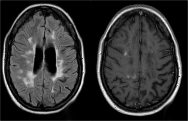 Acute exacerbation of cerebral and spinal MS