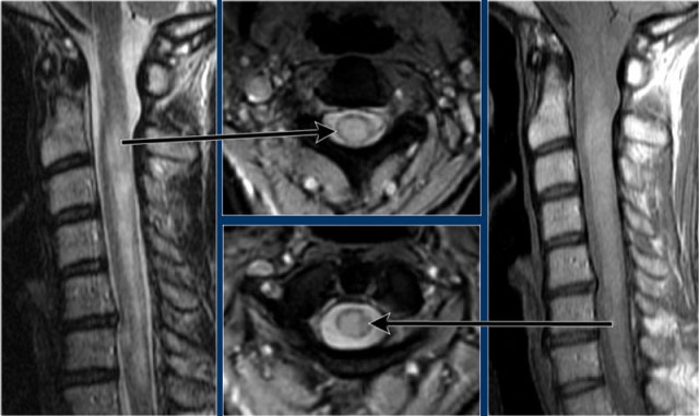 Diffuse abnormalities in MS. Courtesy of Sundgren Pia, Lund, SE