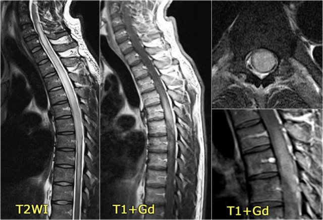 Astrocytoma simulating Transverse myelitis