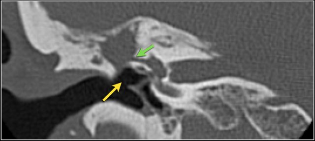 Perforation of the tympanic membrane.