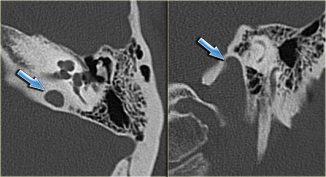 High jugular bulb: axial and coronal image