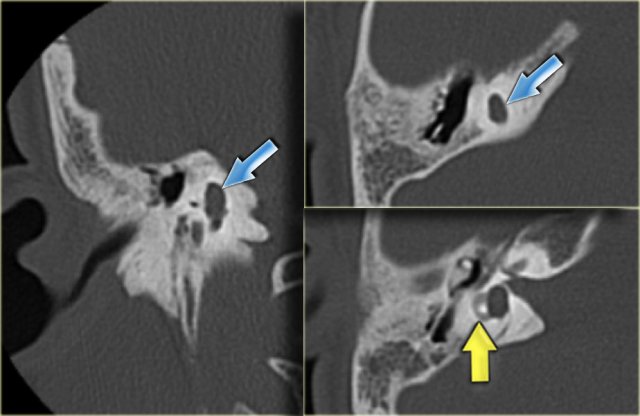 Malformed lateral and superior semicircular canal