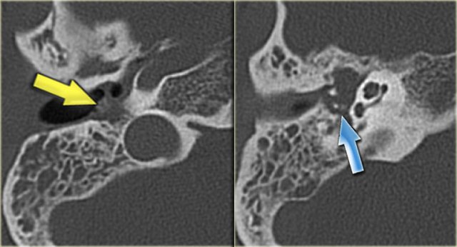 Chronic otitis media