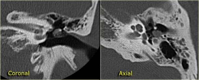 Cholesteatoma