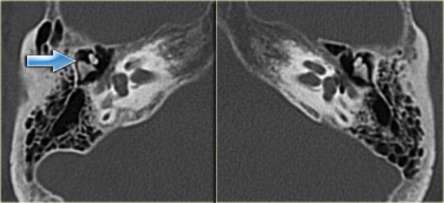 Incus dislocation (arrow)