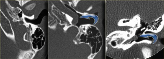 Aberrant internal carotid artery  (courtesy of Hervé Tanghe)