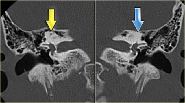 Labyrinthitis ossificans of the left superior semicircular canal (yellow arrow)