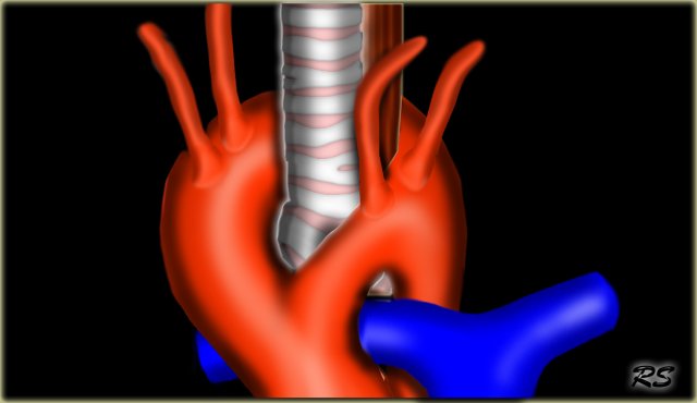 Double Aortic Arch