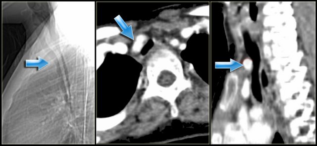 Innominate artery compression syndrome with compression of the trachea