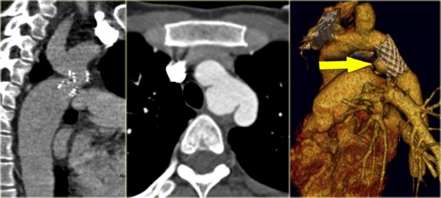 Pseudo-aneurysm in coarctation treated with stent-placement 