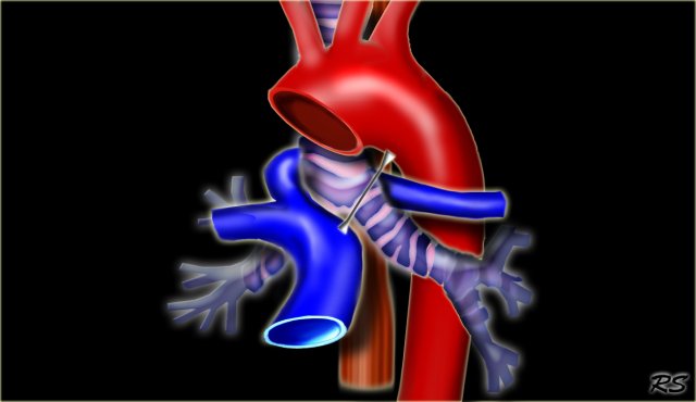 Pulmonary Sling