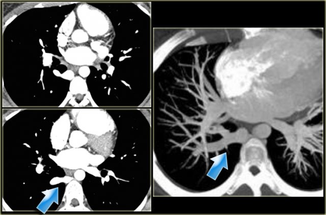 Right lower lobe anomalous venous return into the azygos vein.