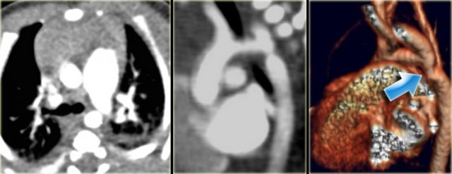 High grade coarctation of aorta not seen on axial images but clearly visualized on sagittal MPR.