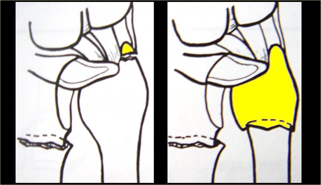 Avulsion of the tip or  stable fractures of the ulnar neck